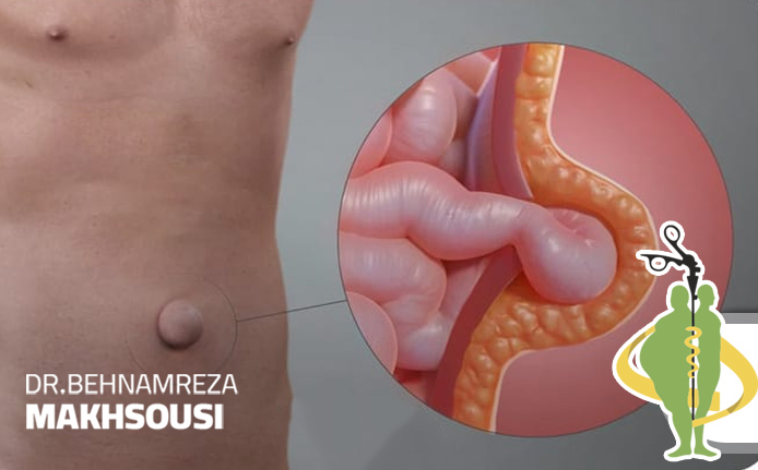 عمل جراحی فتق با روش لاپاراسکوپی