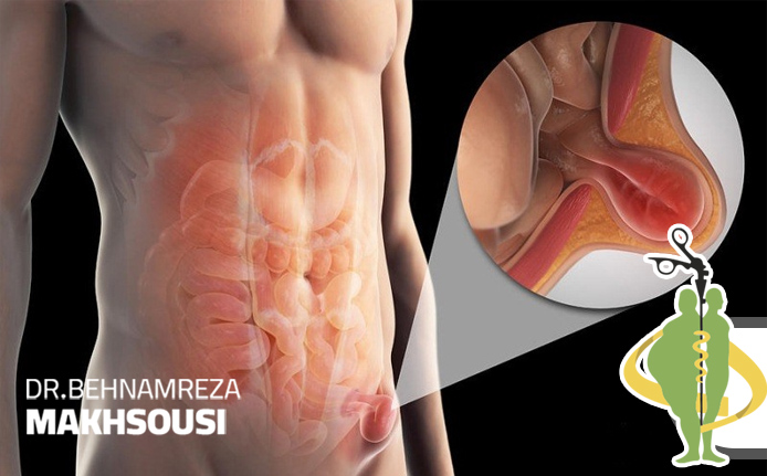 هرنی (فتق) اینگوینال (کشاله ران)