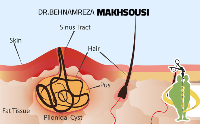 عمل جراحی کیست مویی یا سینوس پایلونیدال